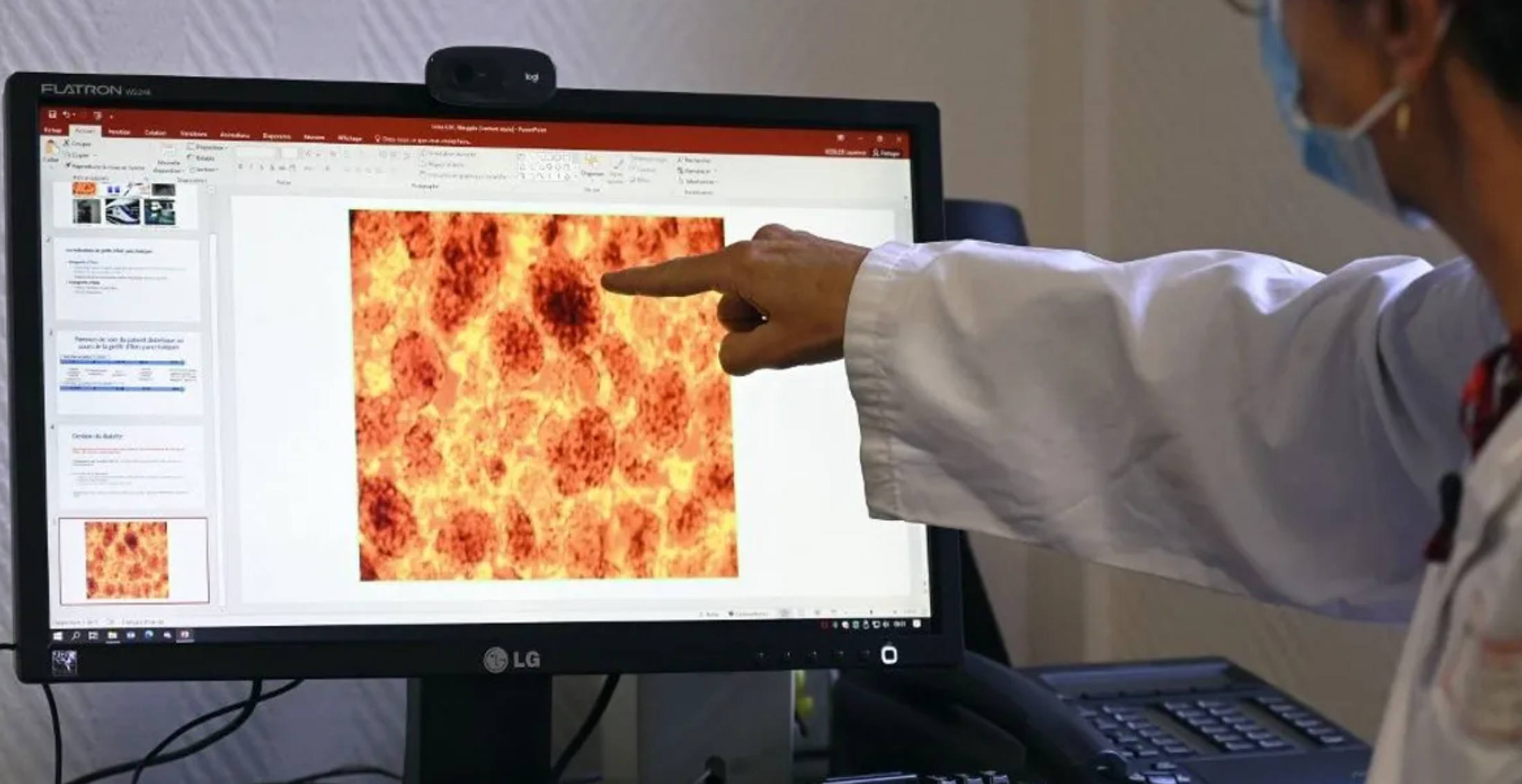 باحثون: لقاح لسرطان البنكرياس يظهر نتائج مبشرة في تجربة أولية باحثون: لقاح لسرطان البنكرياس يظهر نتائج مبشرة في تجربة أولية